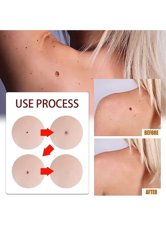 Skin Tag & Mole Remover Pen with Tea Tree Oil.