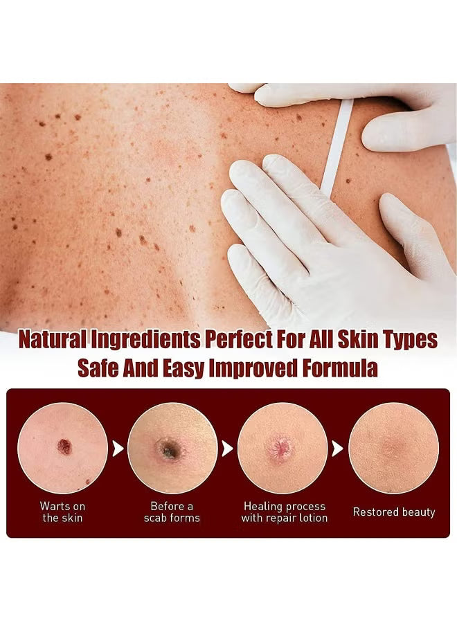 Skin Tag & Mole Remover Pen with Tea Tree Oil.